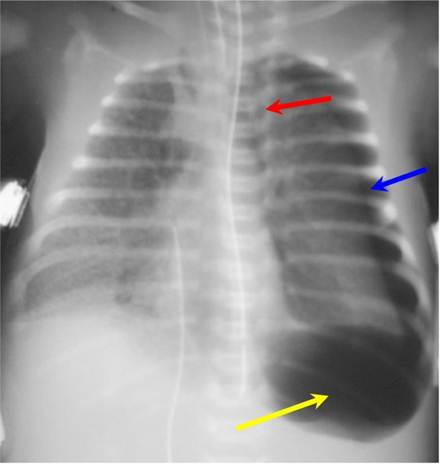 Tension Pneumothorax Mediastinal Shift